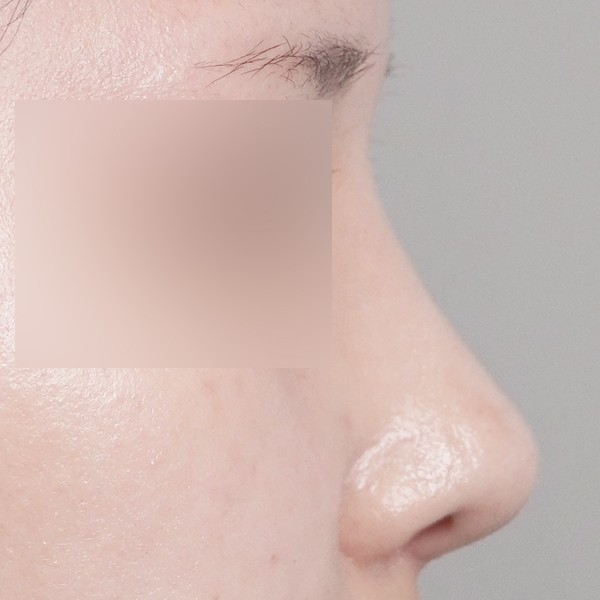 코끝,비중격,귀연골,매부리,절골,복코,휜코,비순각
