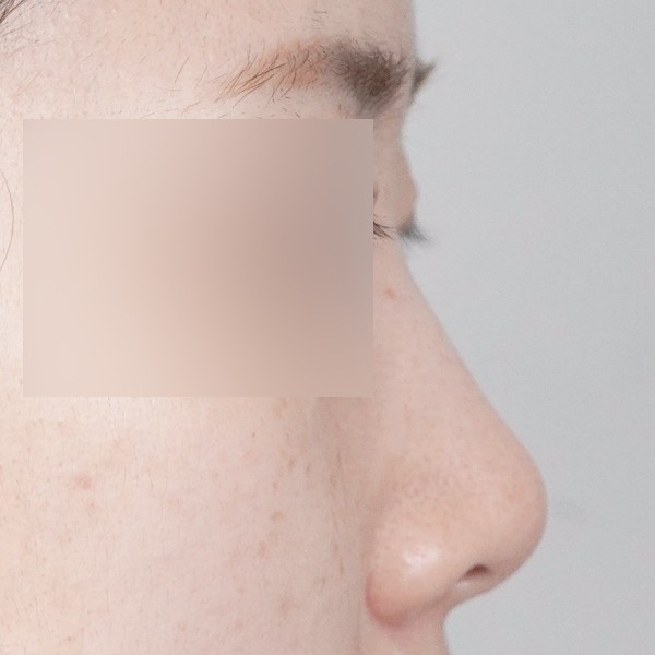 코끝,비중격,귀연골,매부리,복코,절골,짧은코